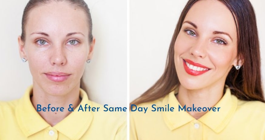 How Dental Veneers Can Transform Your Smile: Cosmetic Treatment Gold Standard