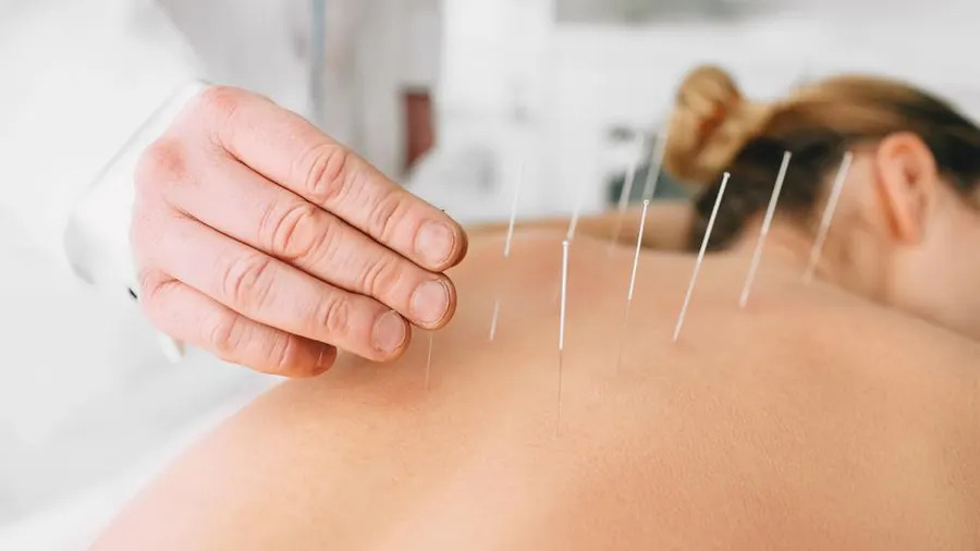 The Role Of Acupuncture In Stress Reduction