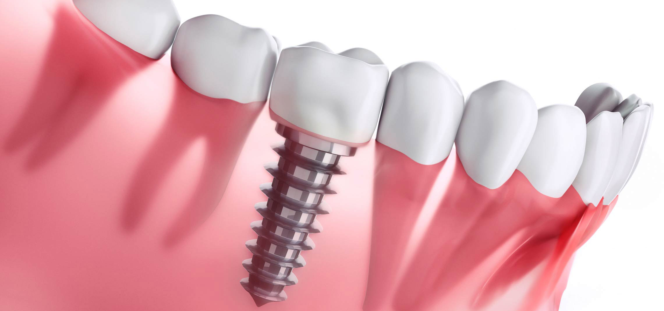 Complete Guide Of Dental Implants